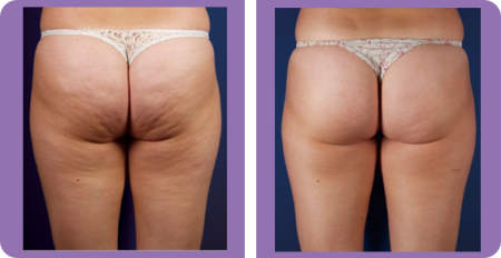 how to get rid of cellulite on bum